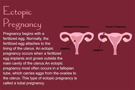 Tubal Ectopic Pregnancy Artofit