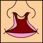 Cleft lip and palate (patient information) - wikidoc