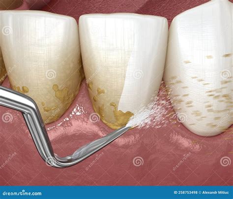 Oral Hygiene Scaling And Root Planing Conventional Periodontal Therapy Medically Accurate 3d