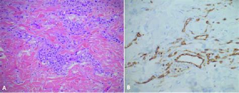 A Histology Showing A Proliferation Of Endothelial Cells In The