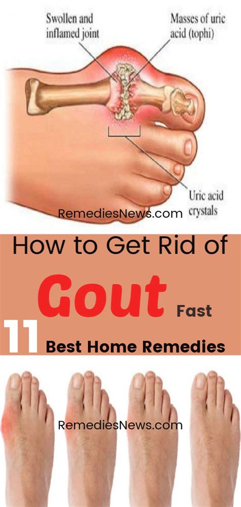 How To Get Rid Of Gout Fast With 11 Best Home Remedies