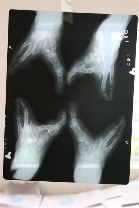 Memorable Case Ectrodactyly
