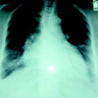 Chest X-ray represents Cardiomegaly. | Download Scientific Diagram