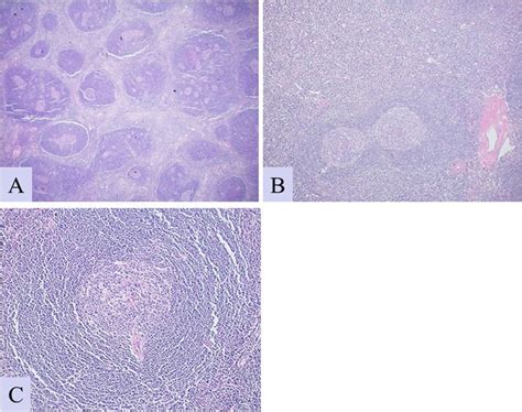 Castleman Disease Lymph Node A Scanning Power Hande View Showing Download Scientific Diagram