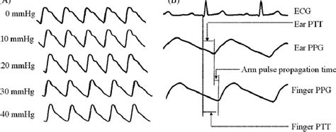 Examples Of The Typical Photoplethysmographic Ppg Waveforms With Cuff