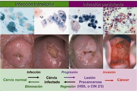 Inf Rmate Sobre El Virus Del Papiloma Humano Vph Detecci N De Virus