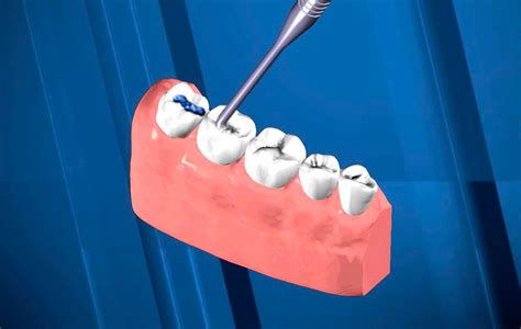 Qué son los selladores dentales Para qué se utilizan Grup Dr Bladé