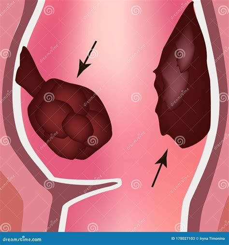 Polyps In The Rectum The Structure Of The Rectum Of The Intestine