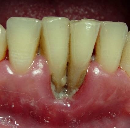 Management Of Periodontal Disease AIDS Institute Clinical Guidelines