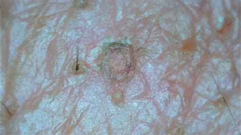 0212 Keratin Plug Removal Cheek Youtube