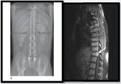 Study of Radiation Therapy Treatment Effect in PAIN Management for ...