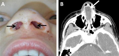 Septal Hematoma: Always Think About It! - The Journal of Pediatrics