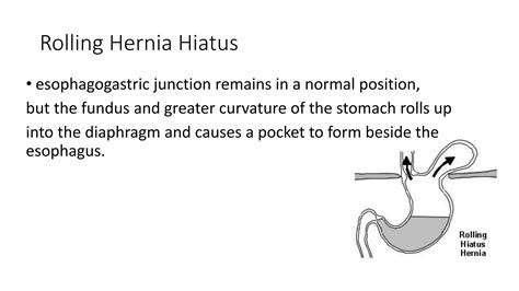 Hernia hiatus | PPT