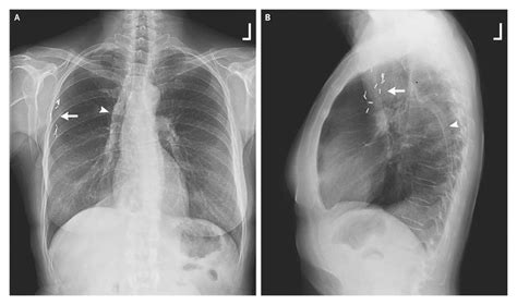 Intrathoracic Rib Nejm