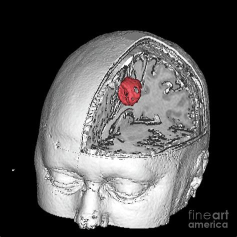 Brain Tumour Photograph By Simon Fraserscience Photo Library Fine Art America