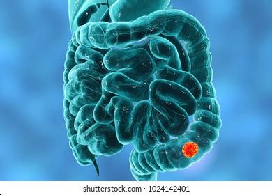 Colorectal Cancer Awareness Medical Concept 3d Stock Illustration