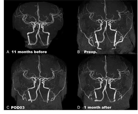 Figure 2 From A Headache Free Reversible Cerebral Vasoconstriction Syndrome Rcvs With