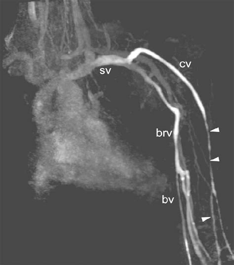 Maximum Intensity Projection Of A Ce Mr Angiogram Of Upper Extremity