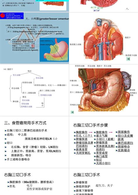 食管癌手术方式ppt 卡卡办公