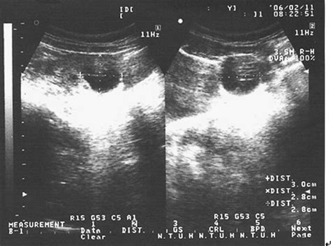 Ovarian Remnant Syndrome At The Port Site Journal Of Minimally