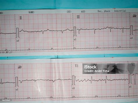 Gambar Elektrokardiogram Atau Ekg Yang Menggambarkan Kelainan Irama