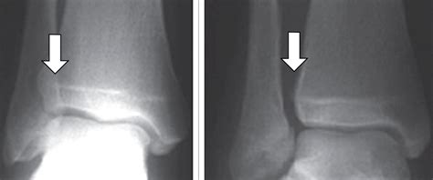 Management Of An Ankle Syndesmotic Injury Sydney Physio Clinic