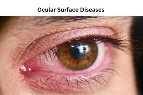 Ocular Surface Diseases Treatment With Herbal Remedies