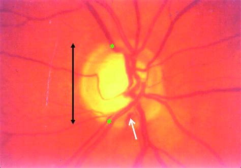 Optic disc showing disc hemorrhage (Rim to disc ratio | Download Scientific Diagram