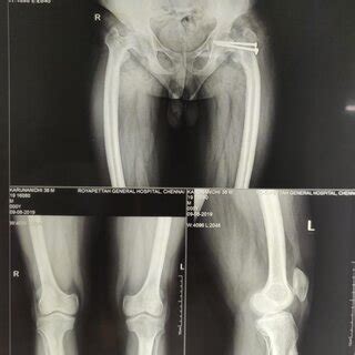 Plain Radiograph Showing Neck Of Femur Non Union At Months Follow Up