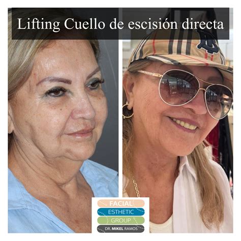 Cirugía Estética Facial Mallorca Lifting cara MACS lift lifting