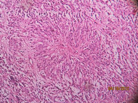 EPENDYMOMA – Histopathology.guru