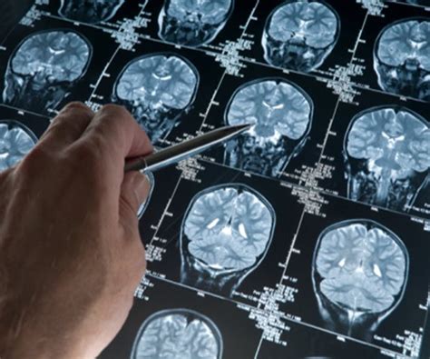 Scans Show Many Vets Have Brain 'Scars' | Newsmax.com