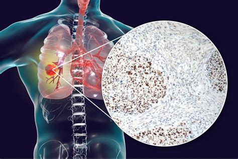 Lung Cancer Proteintech Group