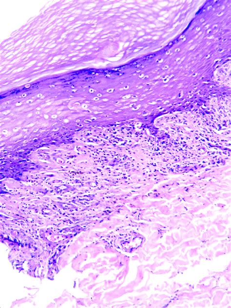 Biopsy 1 From Lichenoid Plaque Showed Compact Orthohyperkeratosis