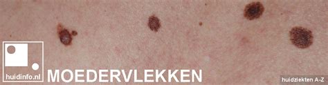 Moedervlekken Veel Fotos Waar Op Letten Info Van De Dermatoloog