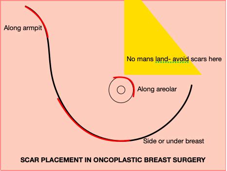 Oncoplastic Breast Surgery For Breast Cancer Cosmesis