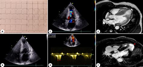 Mid Ventricular Obstruction In Hypertrophic Cardiomyopathy A Signal Void Revista Española De