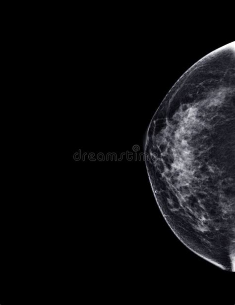 X Ray Digital Mammogram Or Mammography Of Both Side Breast Standard