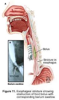 MEDICAL IMAGES: Esophageal stricture