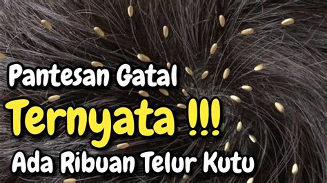 Ada Ribuan Telur Kutu Cari Kutu Rambut Youtube