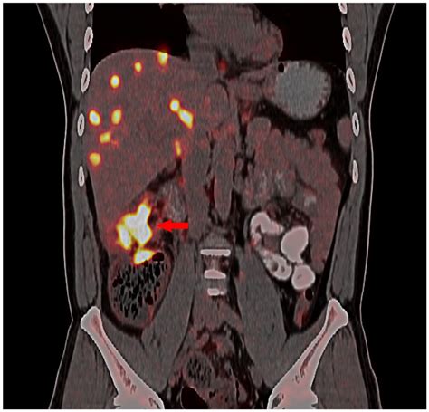 Effective Management Of Advanced Colon Cancer Genotyping Microsatellite