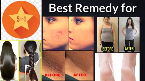 One Best Remedy For Pimples Hair Fall Weight Loss Neck Darkness And