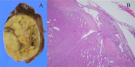 Minimally Invasive Encapsulated Angioinvasive Follicular Thyroid