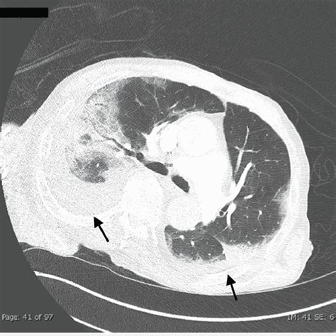 Ctpa Showing Bilateral Pulmonary Parenchymal Opacities And Moderate Download Scientific Diagram