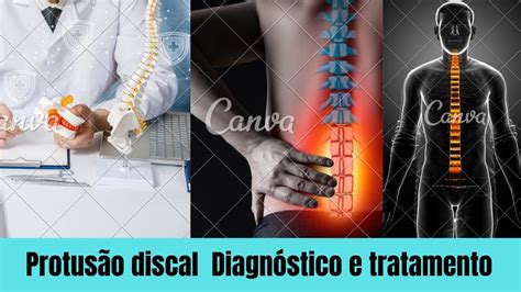 Protusão discal Diagnóstico e tratamento YouTube