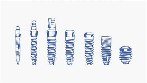 Small-Diameter Dental Implant Posts | Fort Worth, TX