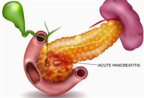 What Are The Most Common Causes Of Acute Pancreatitis Seena Magowitz Foundation