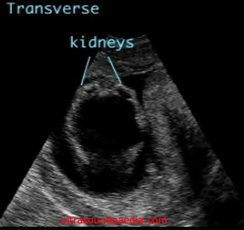 Prune belly syndrome – ULTRASOUNDPAEDIA