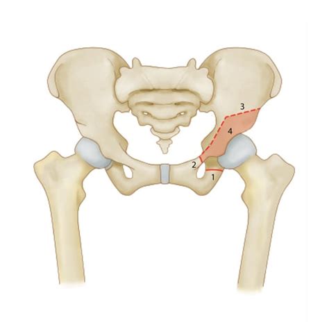 Periacetabular Osteotomy (PAO) Boston Children's Hospital, 41% OFF