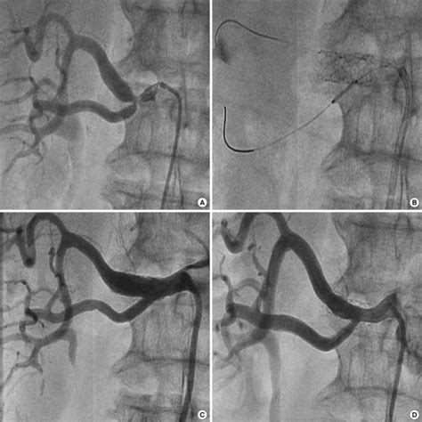 Renal Angiogram Of The Patient A Significant Stenosis At Right Renal Download Scientific